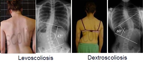 Dextroscoliosis vs Levoscoliosis